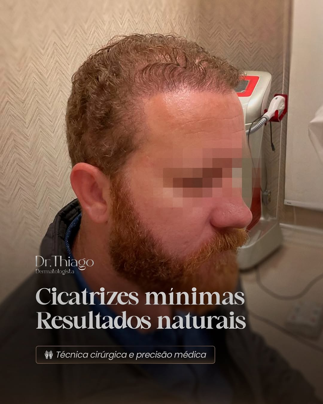Cicatrizes mínimas - Resultados naturais