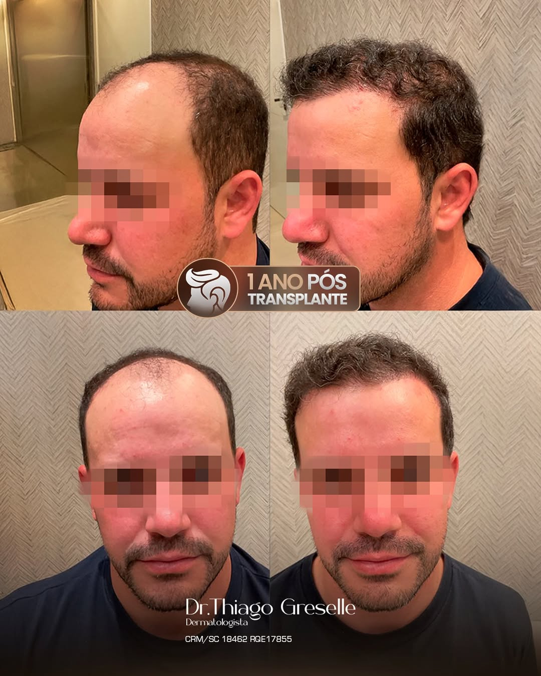 1 ano pós transplante