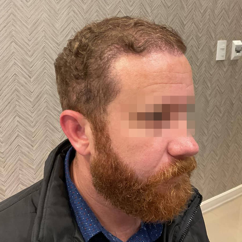 Depois do tratamento